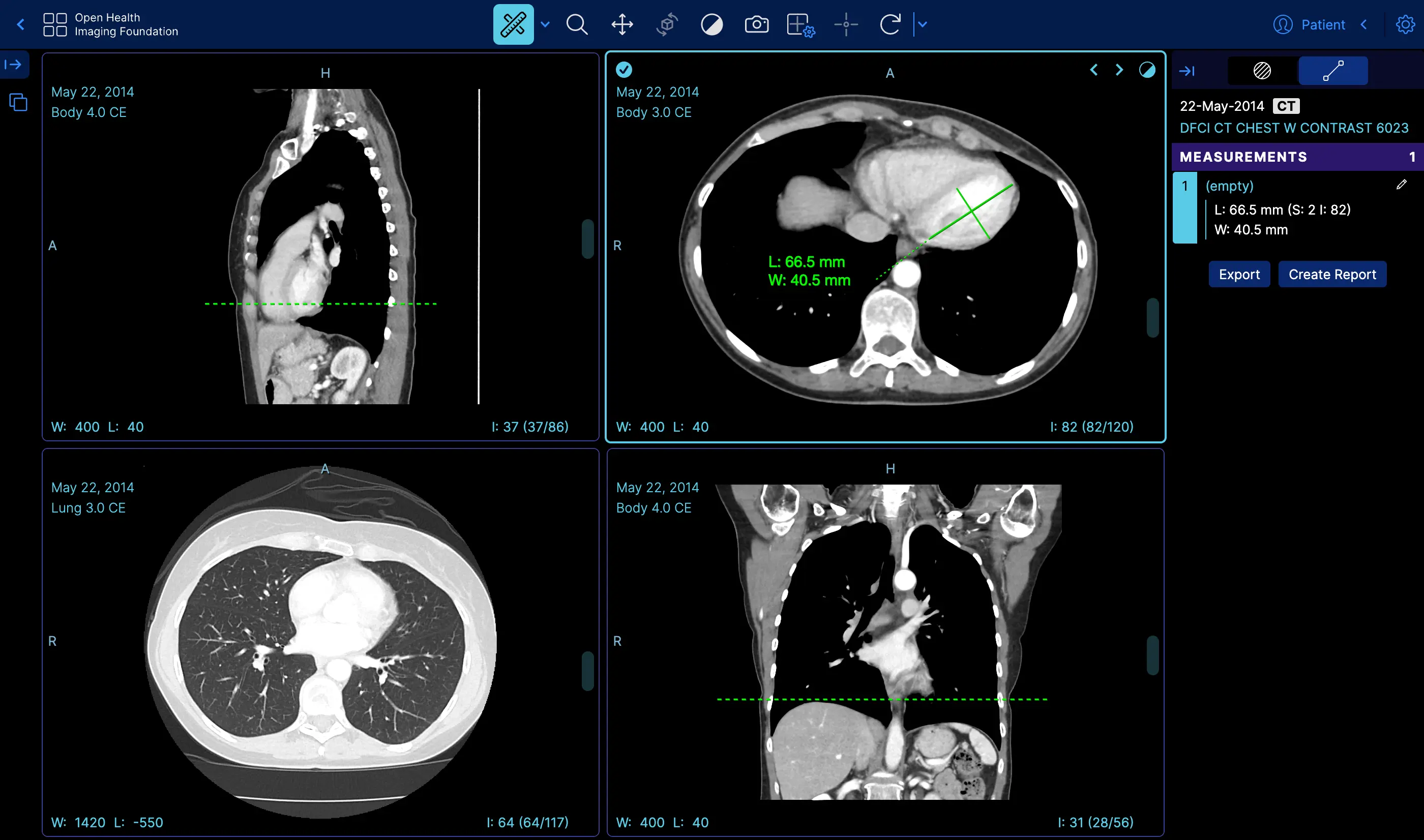 OHIF zero-footprint viewer screenshot showing multi-panel CT views with measurement tools and a browser-based radiology interface.